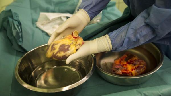 Szívátültetés, transzplantáció, kórház, műtét egészségügy, Városmajori szívklinika
Fotó: Kurucz Árpád