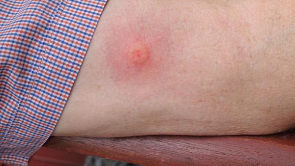 Illusztráció: egeszsegkalauz.hu